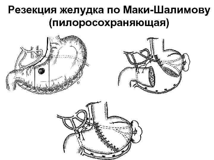 Резекция желудка по витебскому схема операции