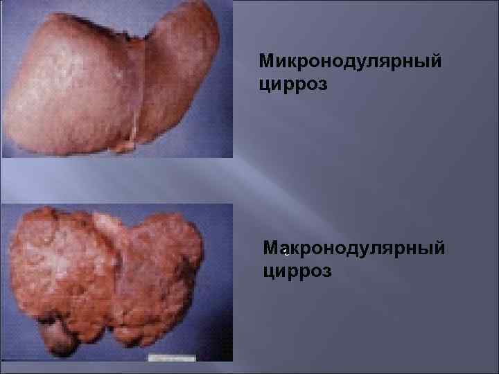 Микронодулярный цирроз Макронодулярный с цирроз 