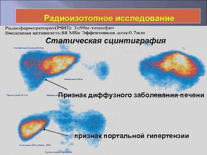 Радиоизотопное исследование Статическая сцинтиграфия Признак диффузного заболевания печени признак портальной гипертензии 