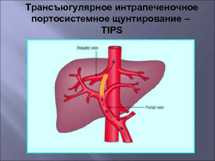 Трансъюгулярное интрапеченочное портосистемное щунтирование – TIPS 