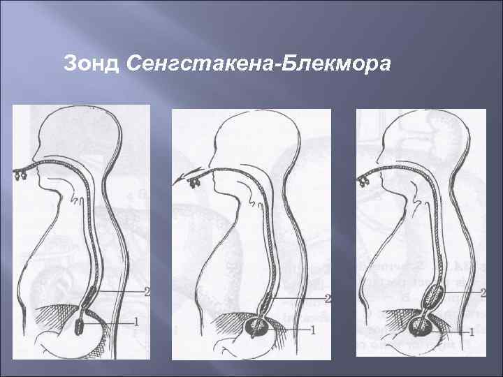 Зонд Сенгстакена-Блекмора 