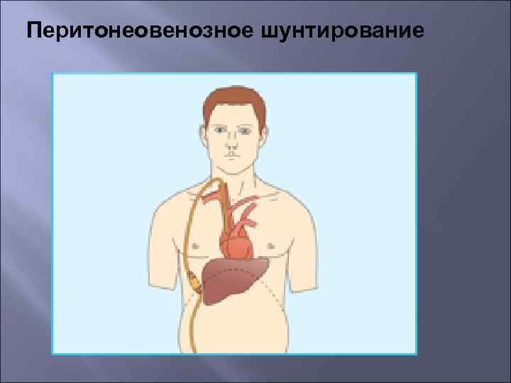 Перитонеовенозное шунтирование 