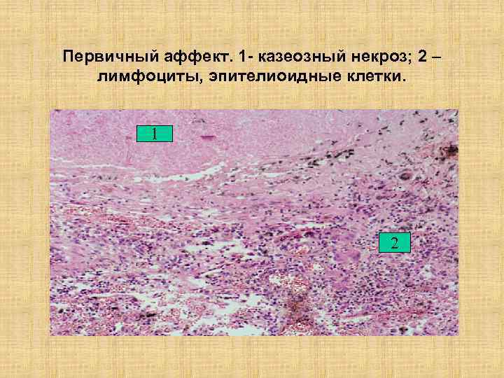 Первичный аффект. 1 - казеозный некроз; 2 – лимфоциты, эпителиоидные клетки. 1 2 