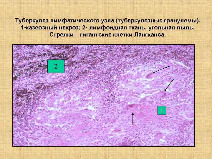 Туберкулез лимфатического узла (туберкулезные гранулемы). 1 -казеозный некроз; 2 - лимфоидная ткань, угольная пыль.