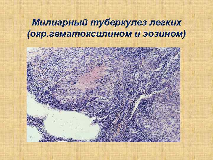 Милиарный туберкулез легких (окр. гематоксилином и эозином) 