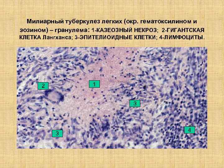 Милиарный туберкулез легких (окр. гематоксилином и эозином) – гранулема: 1 -КАЗЕОЗНЫЙ НЕКРОЗ; 2 -ГИГАНТСКАЯ