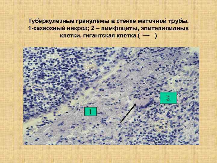 Туберкулезные гранулемы в стенке маточной трубы. 1 -казеозный некроз; 2 – лимфоциты, эпителиоидные клетки,
