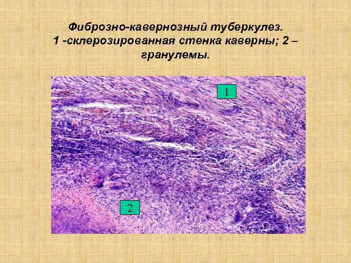 Фиброзно-кавернозный туберкулез. 1 -склерозированная стенка каверны; 2 – гранулемы. 1 2 