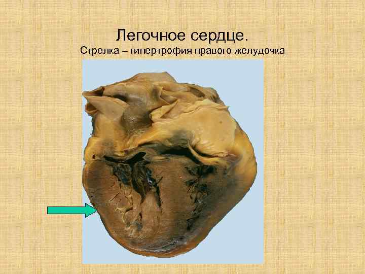 Легочное сердце. Стрелка – гипертрофия правого желудочка 
