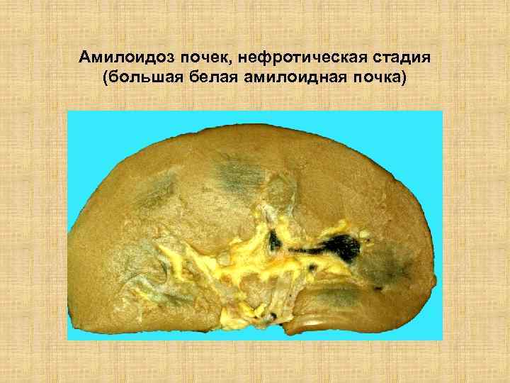 Амилоидоз почек, нефротическая стадия (большая белая амилоидная почка) 