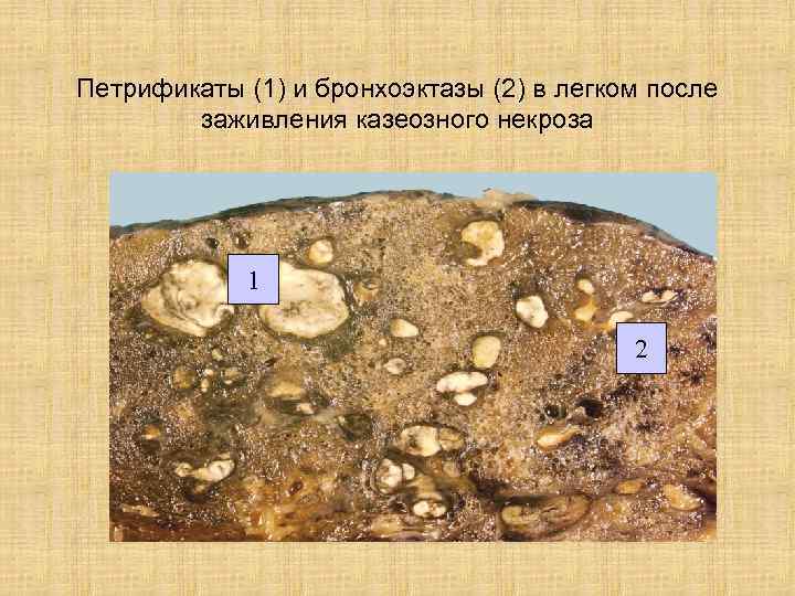 Петрификаты (1) и бронхоэктазы (2) в легком после заживления казеозного некроза 1 2 