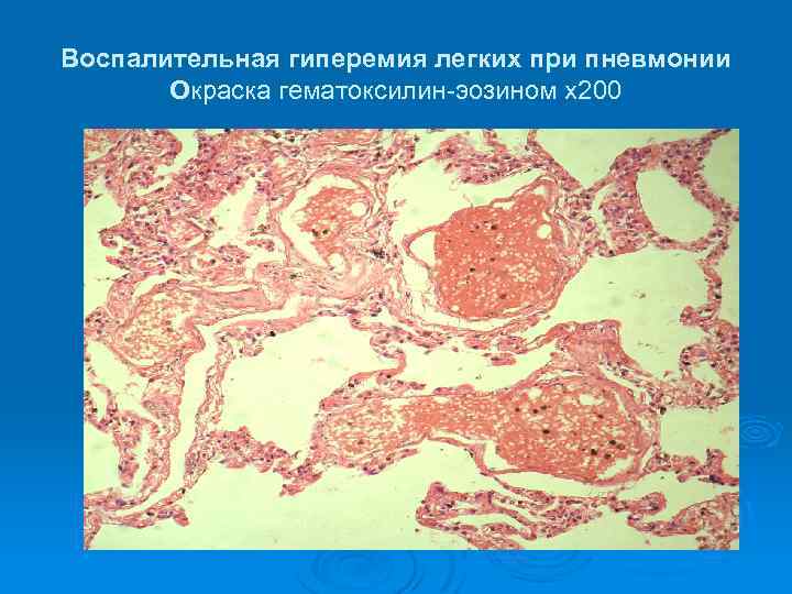 Воспалительная гиперемия легких при пневмонии Окраска гематоксилин-эозином х200 