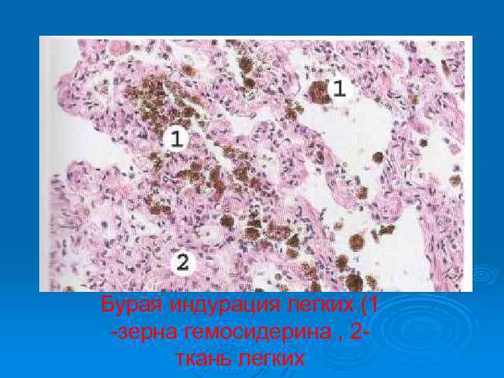 Бурая индурация легких это. Цианотическая индурация почек. Бурая индурация легких микропрепарат. Бурая индурация печени.