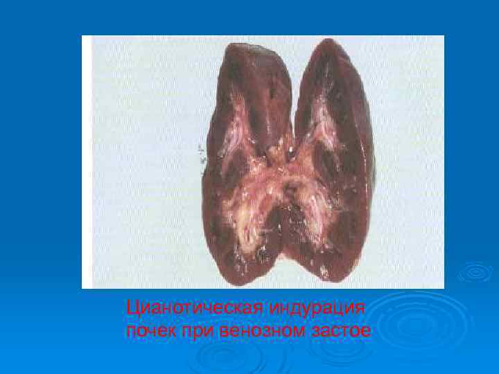 Цианотическая индурация почек при венозном застое 