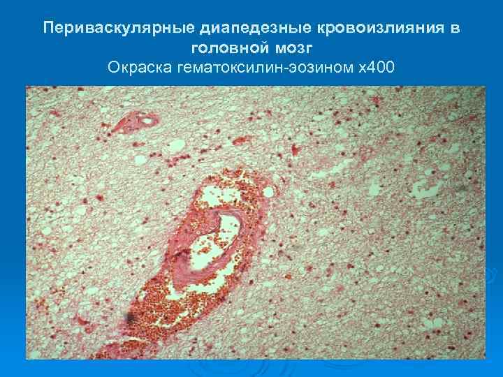 Периваскулярные диапедезные кровоизлияния в головной мозг Окраска гематоксилин-эозином х400 