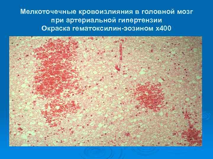 Мелкоточечные кровоизлияния в головной мозг при артериальной гипертензии Окраска гематоксилин-эозином х400 