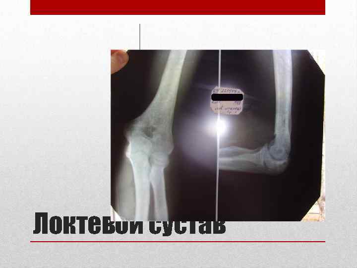 Локтевой сустав 