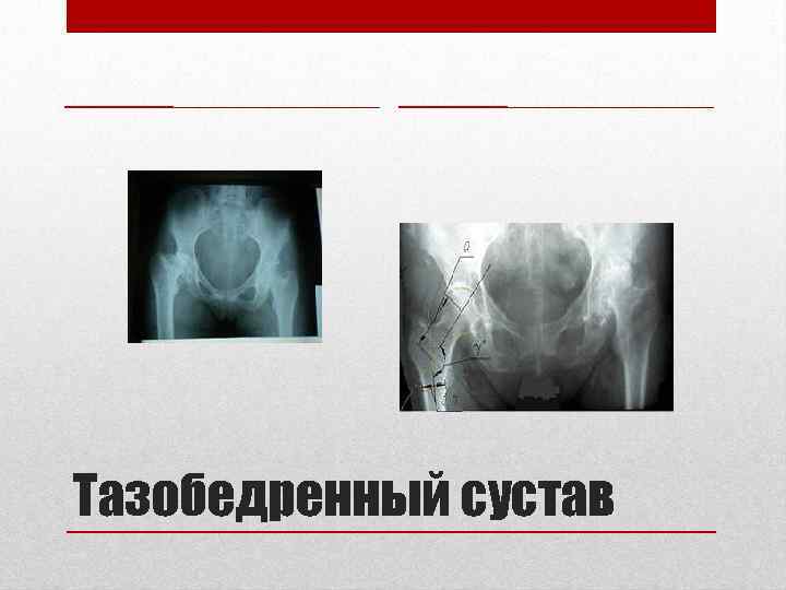 Тазобедренный сустав 