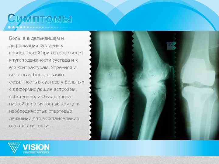 Боль, а в дальнейшем и деформация суставных поверхностей при артрозе ведет к тугоподвижности сустава