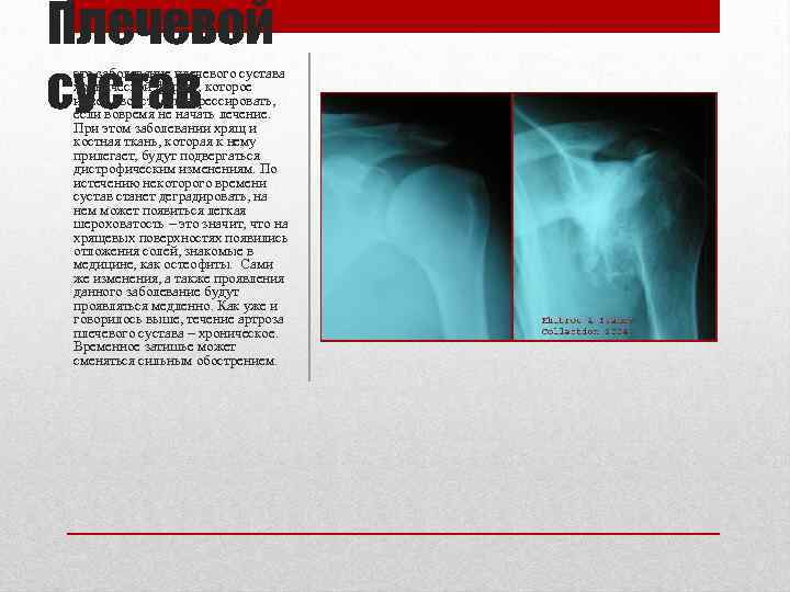Плечевой сустав это заболевание плечевого сустава хронической формы, которое имеет свойство прогрессировать, если вовремя