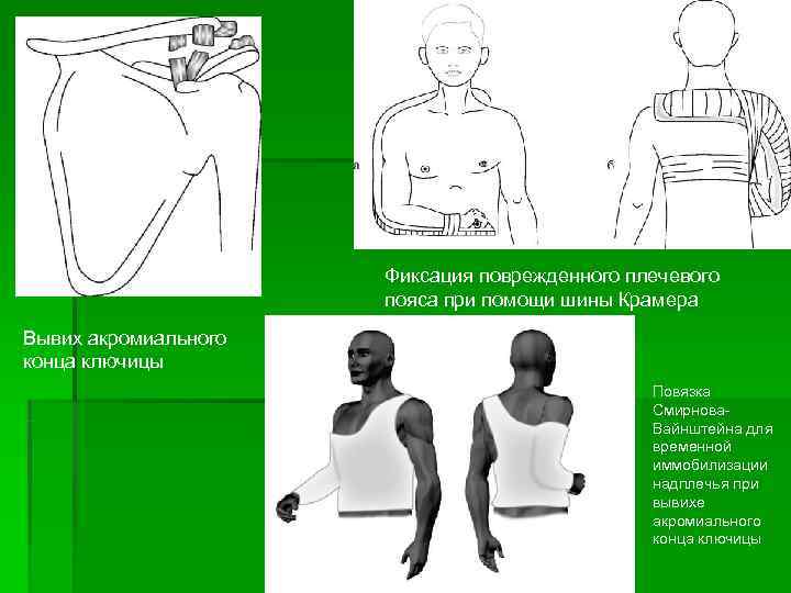 Перелом ключицы карта вызова