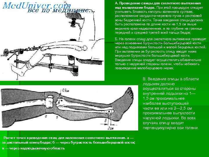      А. Проведение спицы для скелетного вытяжения   