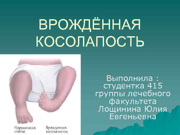 ВРОЖДЁННАЯ КОСОЛАПОСТЬ Выполнила : студентка 415 группы лечебного факультета ВРОЖДЁННАЯ КОСОЛАПОСТЬ Выполнила : студентка 415 группы лечебного факультета