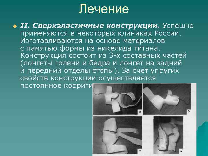 Лечение u II. Сверхэластичные конструкции. Успешно применяются в некоторых клиниках Лечение u II. Сверхэластичные конструкции. Успешно применяются в некоторых клиниках