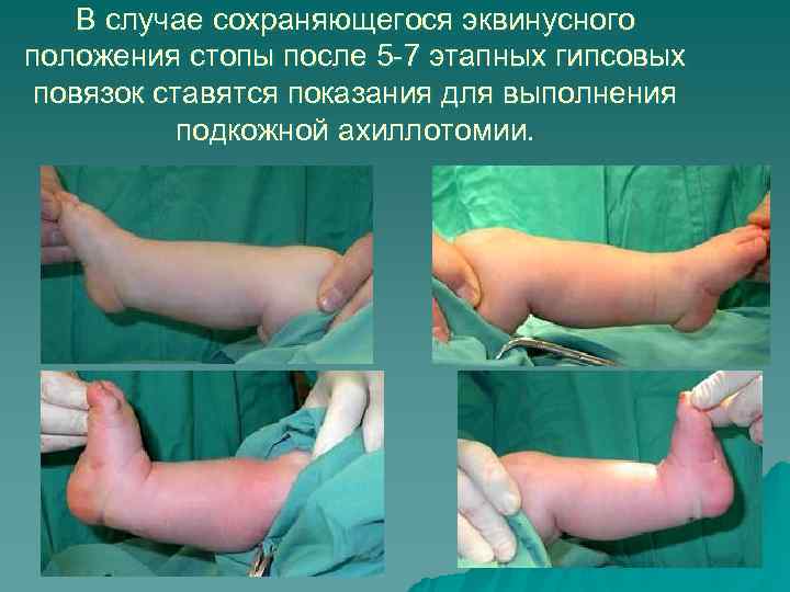 В случае сохраняющегося эквинусного положения стопы после 5 -7 этапных гипсовых В случае сохраняющегося эквинусного положения стопы после 5 -7 этапных гипсовых