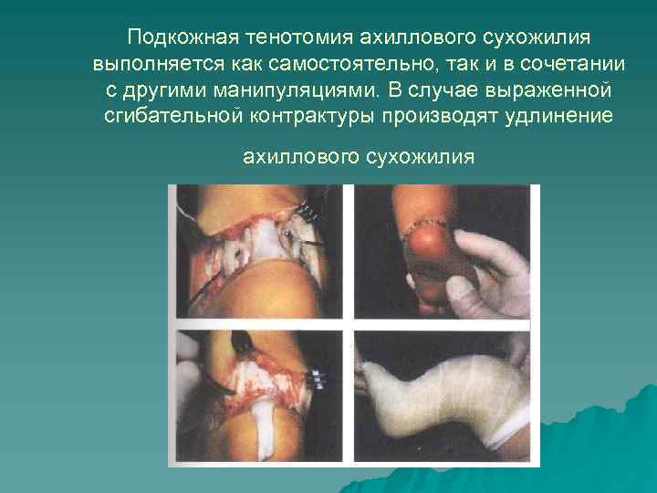 Подкожная тенотомия ахиллового сухожилия выполняется как самостоятельно, так и в сочетании Подкожная тенотомия ахиллового сухожилия выполняется как самостоятельно, так и в сочетании