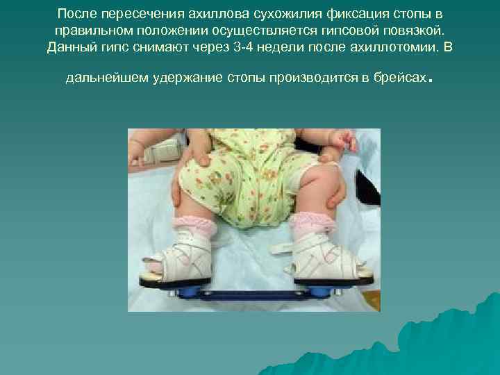 После пересечения ахиллова сухожилия фиксация стопы в правильном положении осуществляется гипсовой повязкой. После пересечения ахиллова сухожилия фиксация стопы в правильном положении осуществляется гипсовой повязкой.