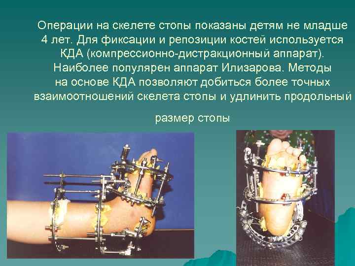 Операции на скелете стопы показаны детям не младше 4 лет. Для фиксации Операции на скелете стопы показаны детям не младше 4 лет. Для фиксации