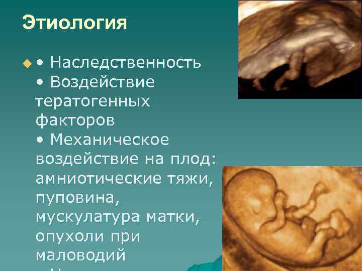 Этиология u • Наследственность • Воздействие тератогенных факторов • Механическое Этиология u • Наследственность • Воздействие тератогенных факторов • Механическое