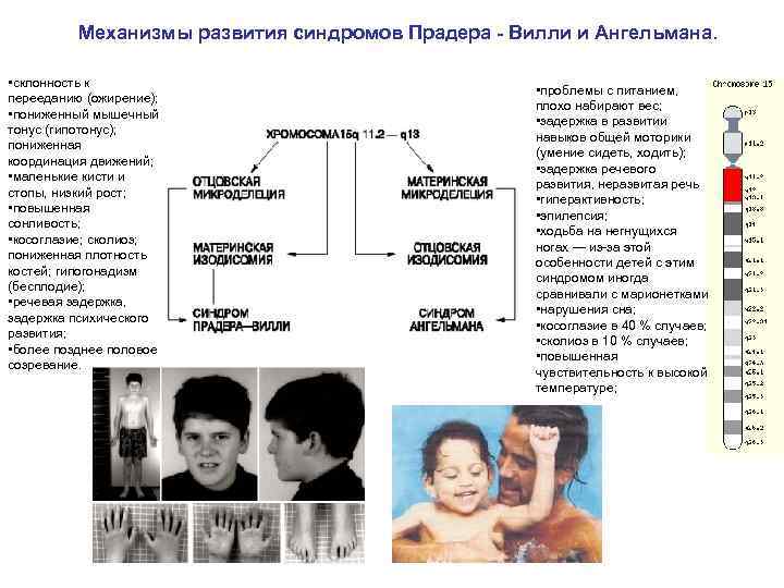 Механизмы развития синдромов Прадера - Вилли и Ангельмана. • склонность к перееданию (ожирение); •
