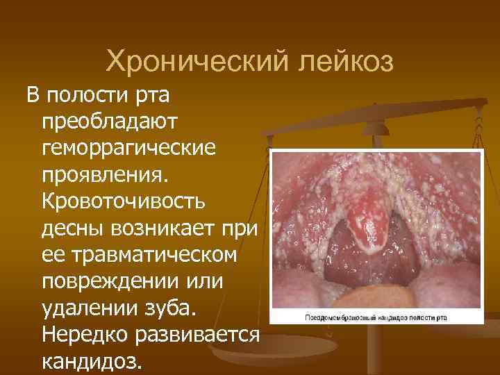 Хронический лейкоз В полости рта преобладают геморрагические проявления. Кровоточивость десны возникает при ее травматическом