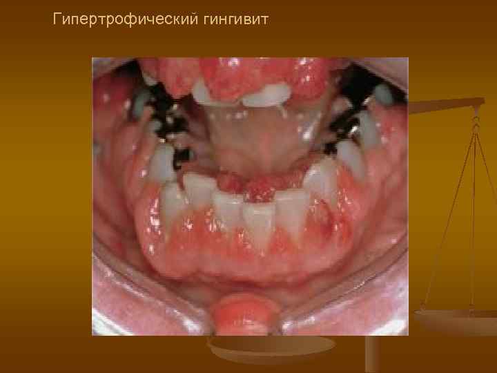 Гипертрофический гингивит 