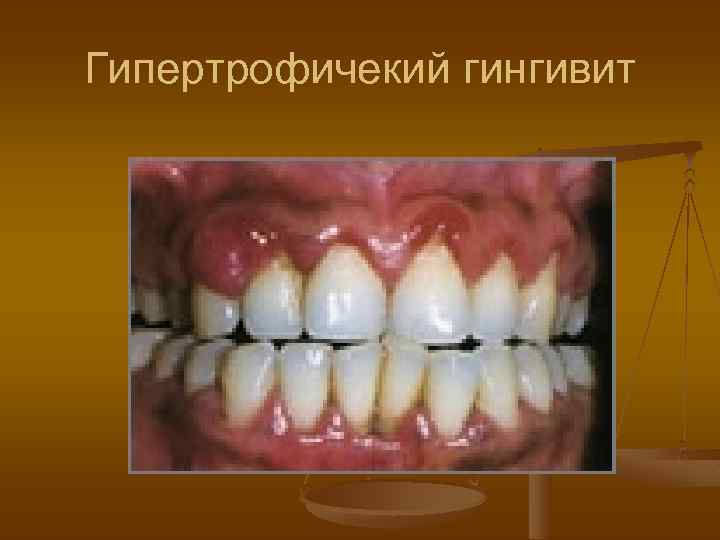 Гипертрофичекий гингивит 