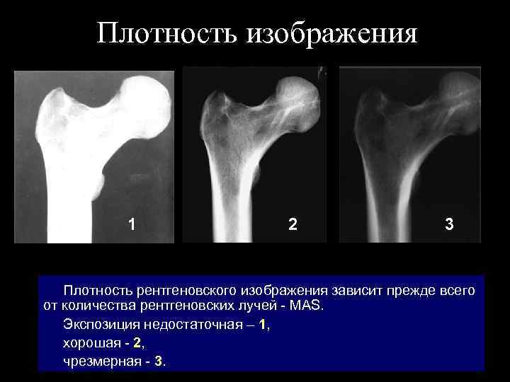 Плотность изображения 1 2 3 Плотность рентгеновского изображения зависит прежде всего от количества рентгеновских