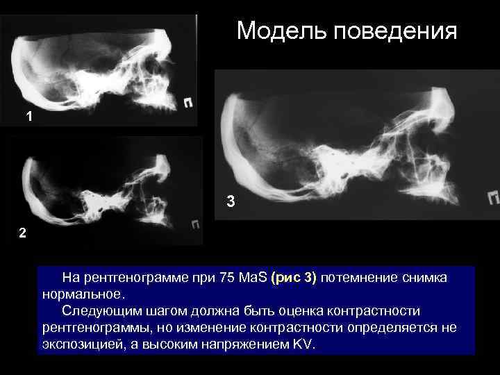 Модель поведения 1 3 2 На рентгенограмме при 75 Ма. S (рис 3) потемнение