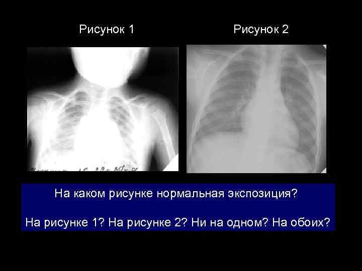 Рисунок 1 Рисунок 2 На каком рисунке нормальная экспозиция? На рисунке 1? На рисунке
