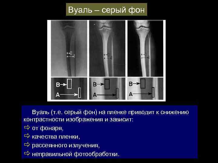 Вуаль – серый фон Вуаль (т. е. серый фон) на пленке приводит к снижению