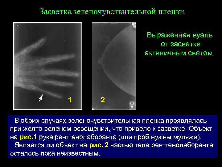 Засветка зеленочувствительной пленки Выраженная вуаль от засветки актиничным светом. 1 2 В обоих случаях