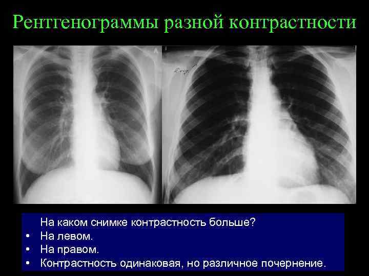 Рентгенограммы разной контрастности На каком снимке контрастность больше? • На левом. • На правом.