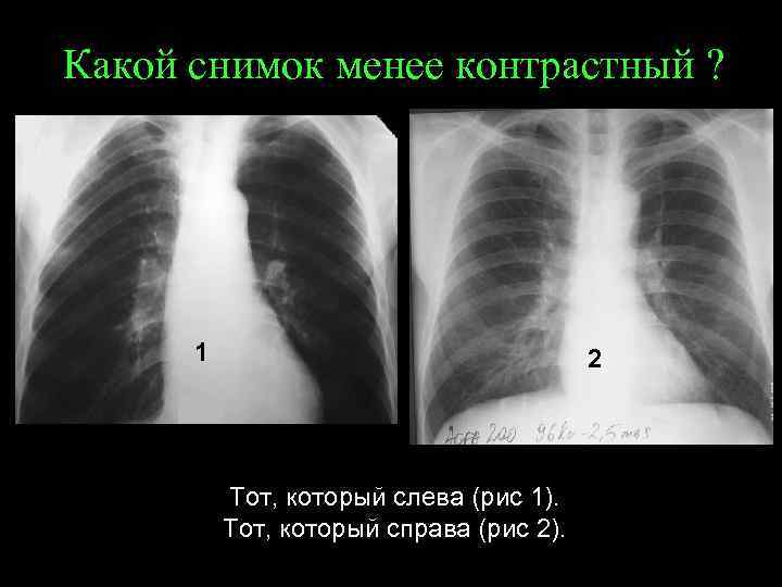 Какой снимок менее контрастный ? 1 2 Тот, который слева (рис 1). Тот, который