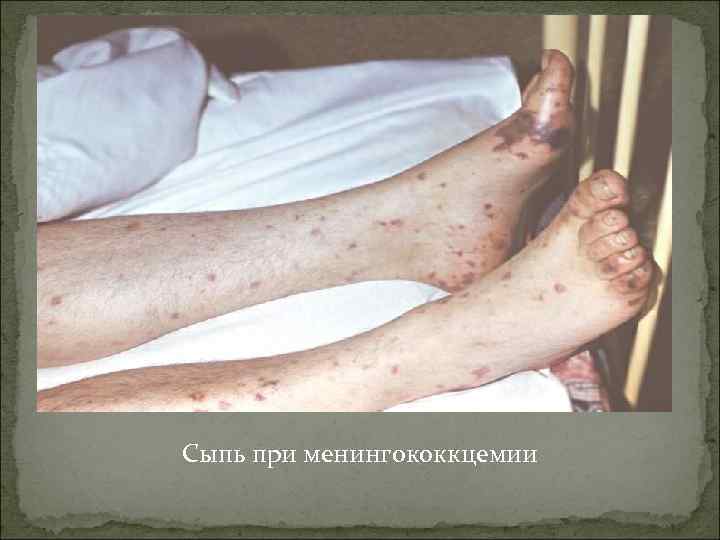 Сыпь при менингококкцемии 