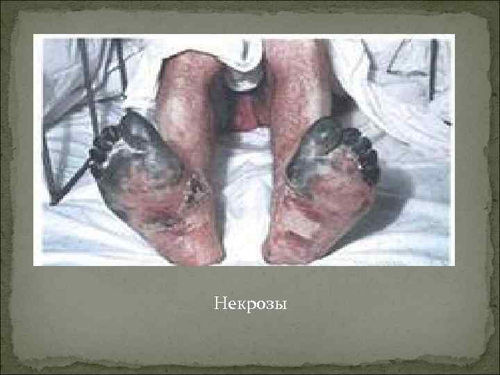Некрозы 