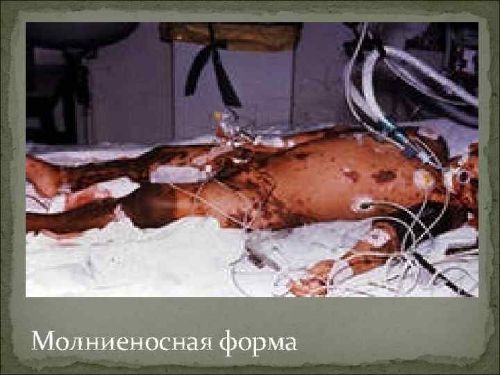 Молниеносная форма 