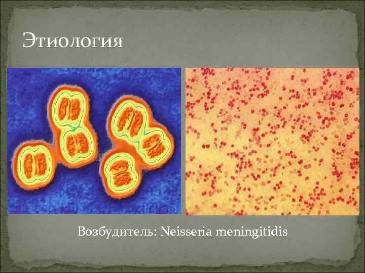 Этиология Возбудитель: Neisseria meningitidis 
