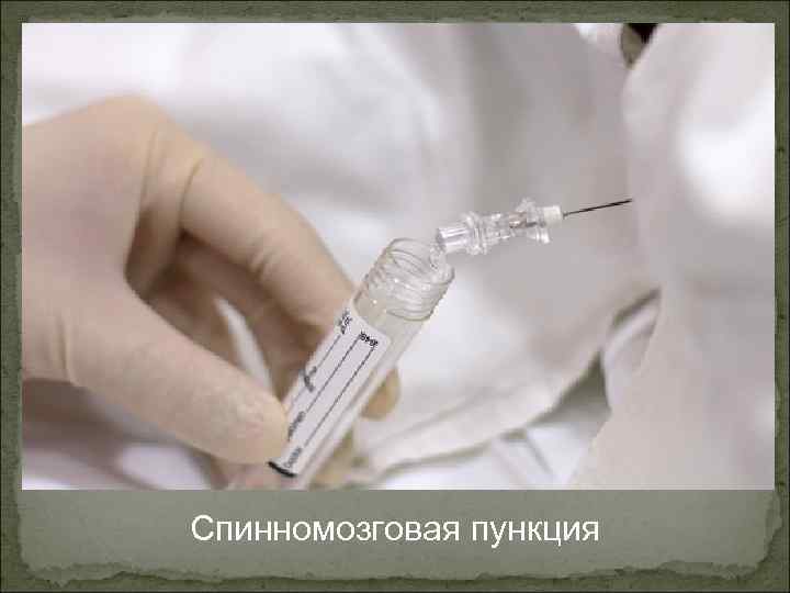 Спинномозговая пункция 