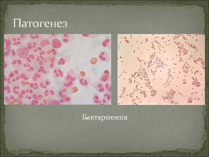 Патогенез Бактериемия 